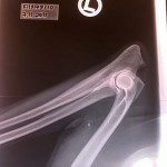 GS Brainpicker elbow x-ray, November 2011